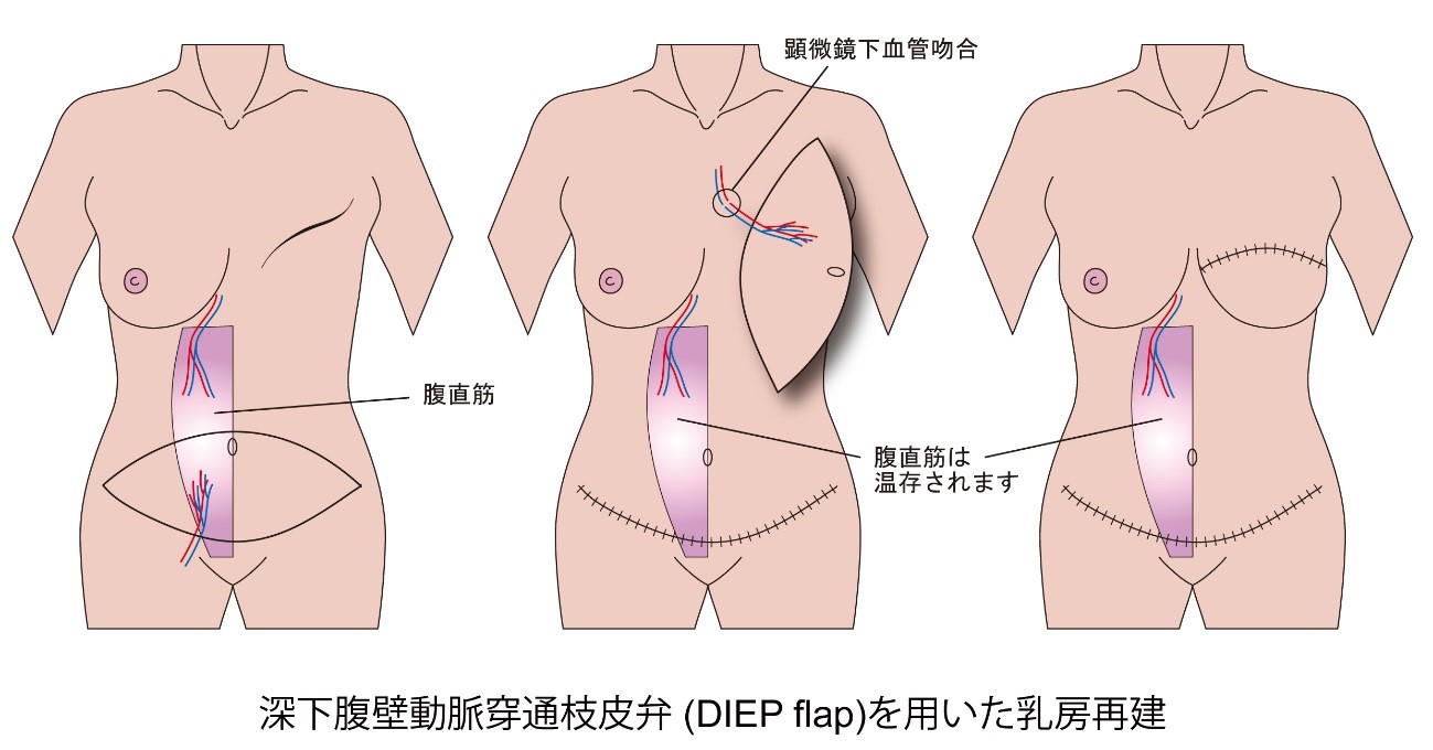 深化腹壁動脈穿通枝皮弁（DIEP flap）を用いた乳房再建
