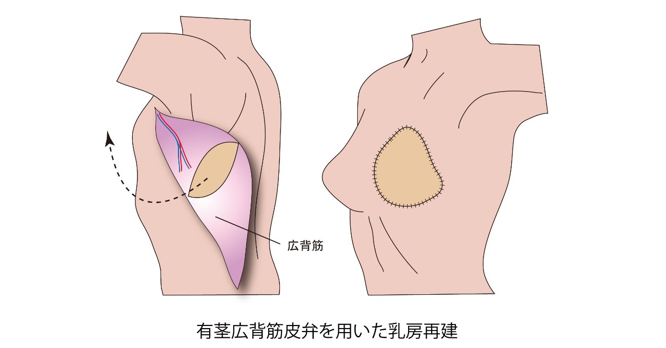 有茎広背筋皮弁を用いた乳房再建
