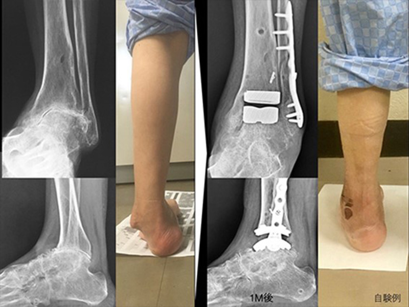 TAA（人工足関節置換術）