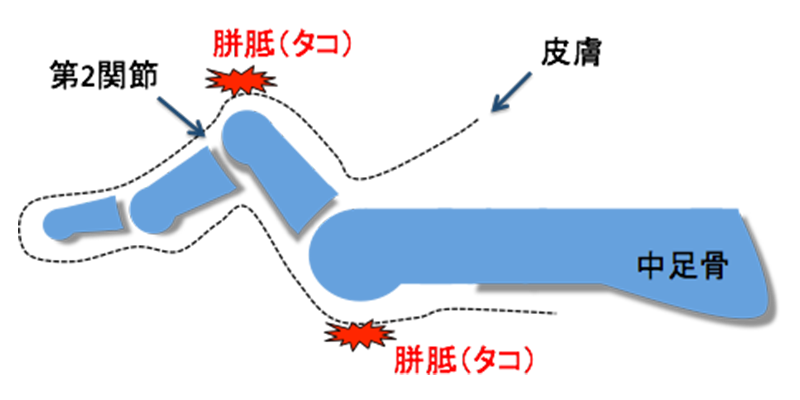 TAA（人工足関節置換術）