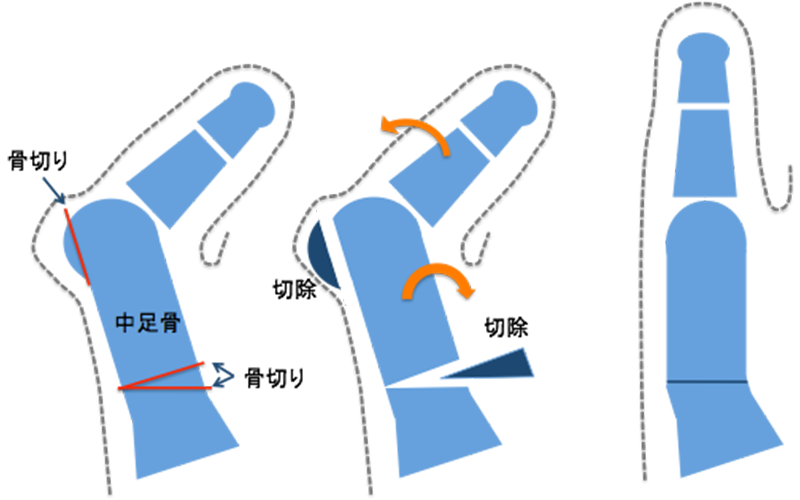 中足骨骨切り術