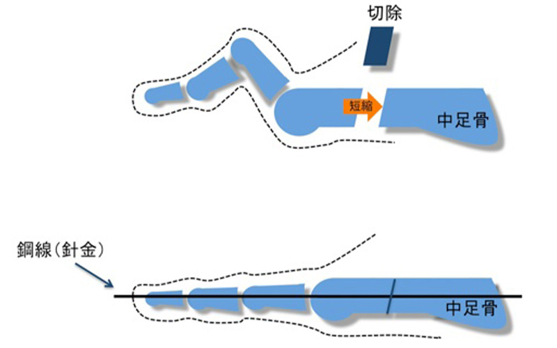 中足骨短縮骨切り術