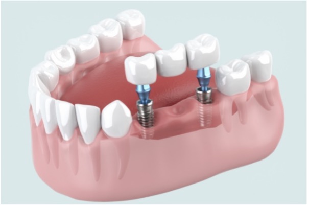 歯科インプラント治療